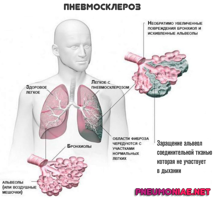 Легочный рисунок с признаками пневмосклероза что это