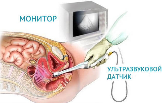 узи половых органов перед стерилизацией женщины